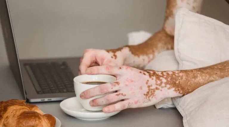 quem tem vitiligo pode fazer depilação a laser