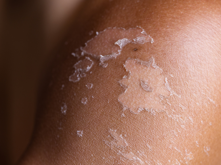 Alergia à Depilação a Laser: Descubra Como Mitigar Riscos