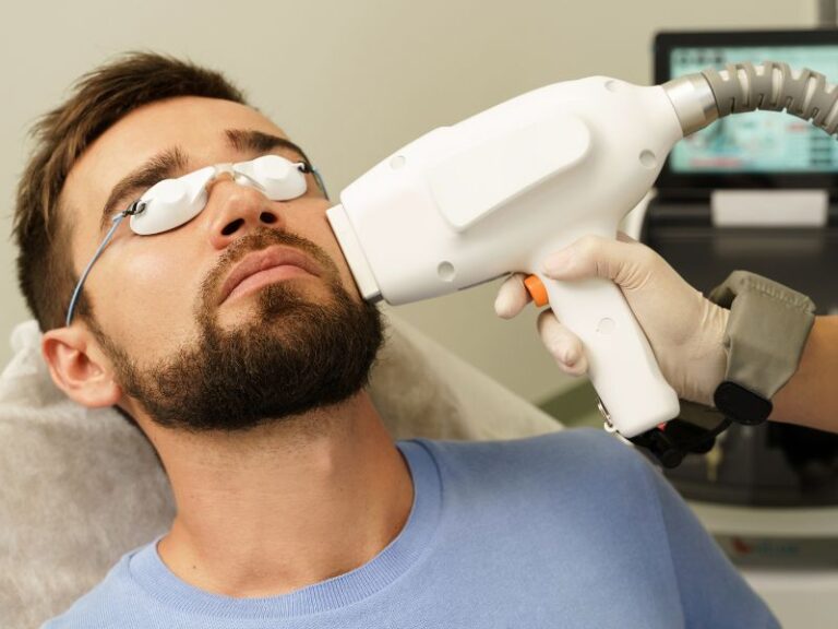 técnica de depilação a laser na barba