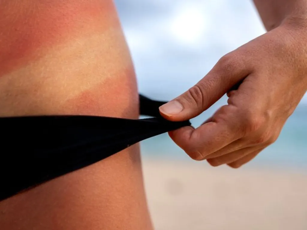 queimadura de depilação a laser vermelhidão