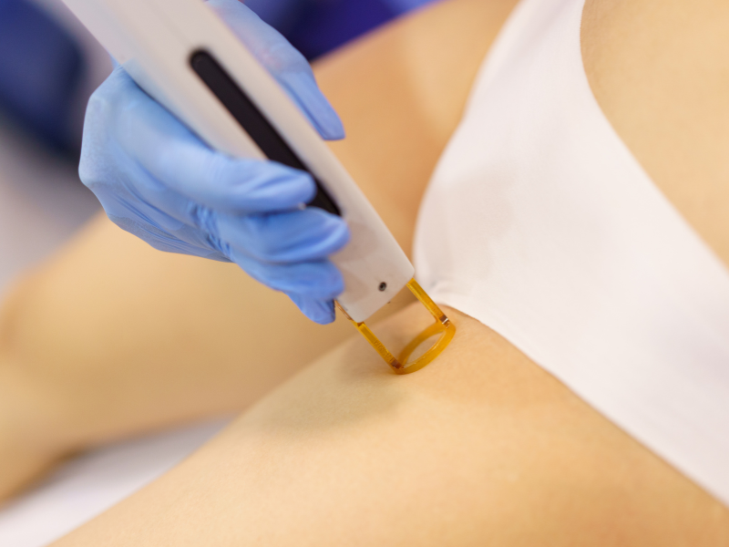 depilação a laser virilha cavada cuidados