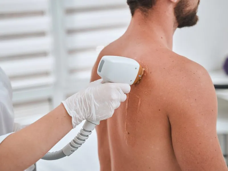 áreas para depilação a laser procedimento