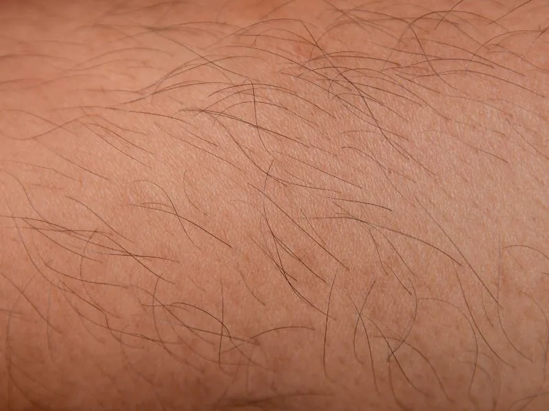 pode puxar os pelos depois da depilação a laser